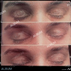 Rapid Eye