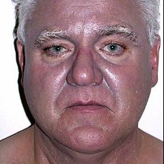Argyria